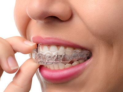 The image shows a person with an orthodontic appliance, possibly a clear aligner or retainer, placed over their teeth, and they are holding it up to their mouth with one hand.