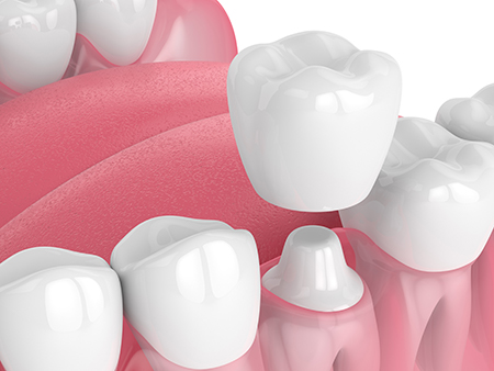 The image features a close-up of multiple rows of artificial teeth with varying shades of pink and white, arranged in a dental implant setup against a plain background.
