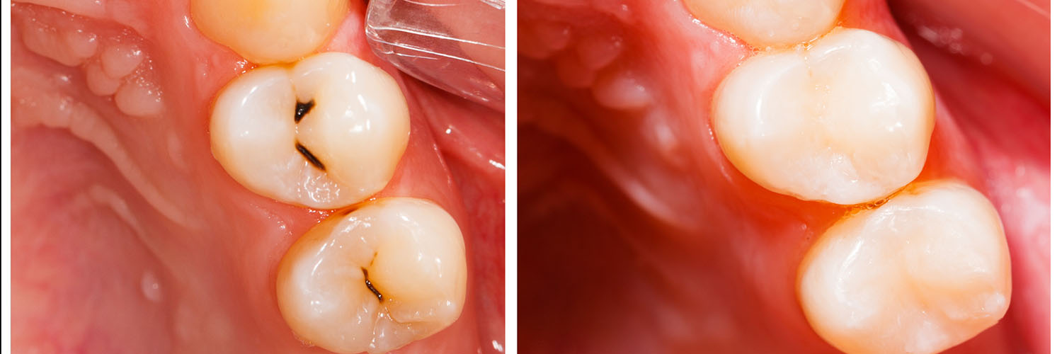The image shows a close-up view of a mouth with multiple teeth, including front teeth with cavities and back teeth with fillings, against a blurred background.