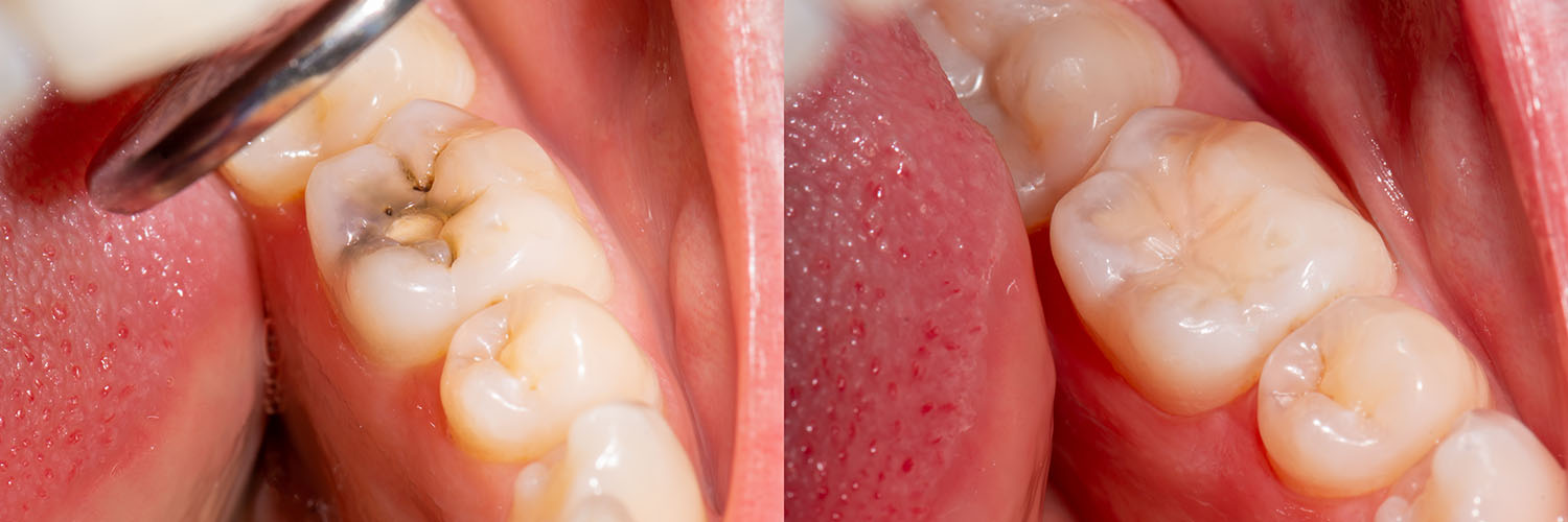 The image shows a close-up view of a person s mouth with multiple teeth missing, revealing the inside of their dental structure, including gums and tongue, with an object that appears to be a toothbrush in the lower right corner.