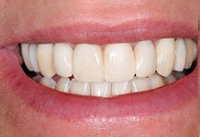 The image shows a person with a wide smile displaying straight white teeth, which suggests good oral hygiene.