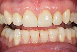 The image shows a close-up view of a person s mouth with teeth that appear yellowed and stained, suggesting poor oral hygiene or the need for dental care.
