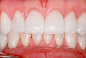 The image displays a close-up view of a person s teeth with a focus on a large gap between the front teeth, showcasing dental imperfections such as yellowing and staining.