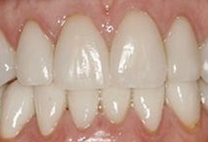 The image shows a close-up of a person s teeth with a focus on a crooked front tooth.