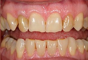 The image shows two photographs of a person s teeth with significant decay and discoloration  the upper photo displays a close-up view, while the lower one provides a wider perspective.