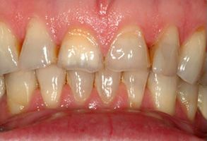 The image shows a close-up view of a person s teeth with noticeable yellowing and staining, indicating poor oral hygiene.