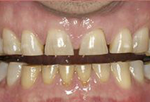 The image shows a person s mouth with discolored teeth and a metal bracket holding them together, indicating dental work in progress.